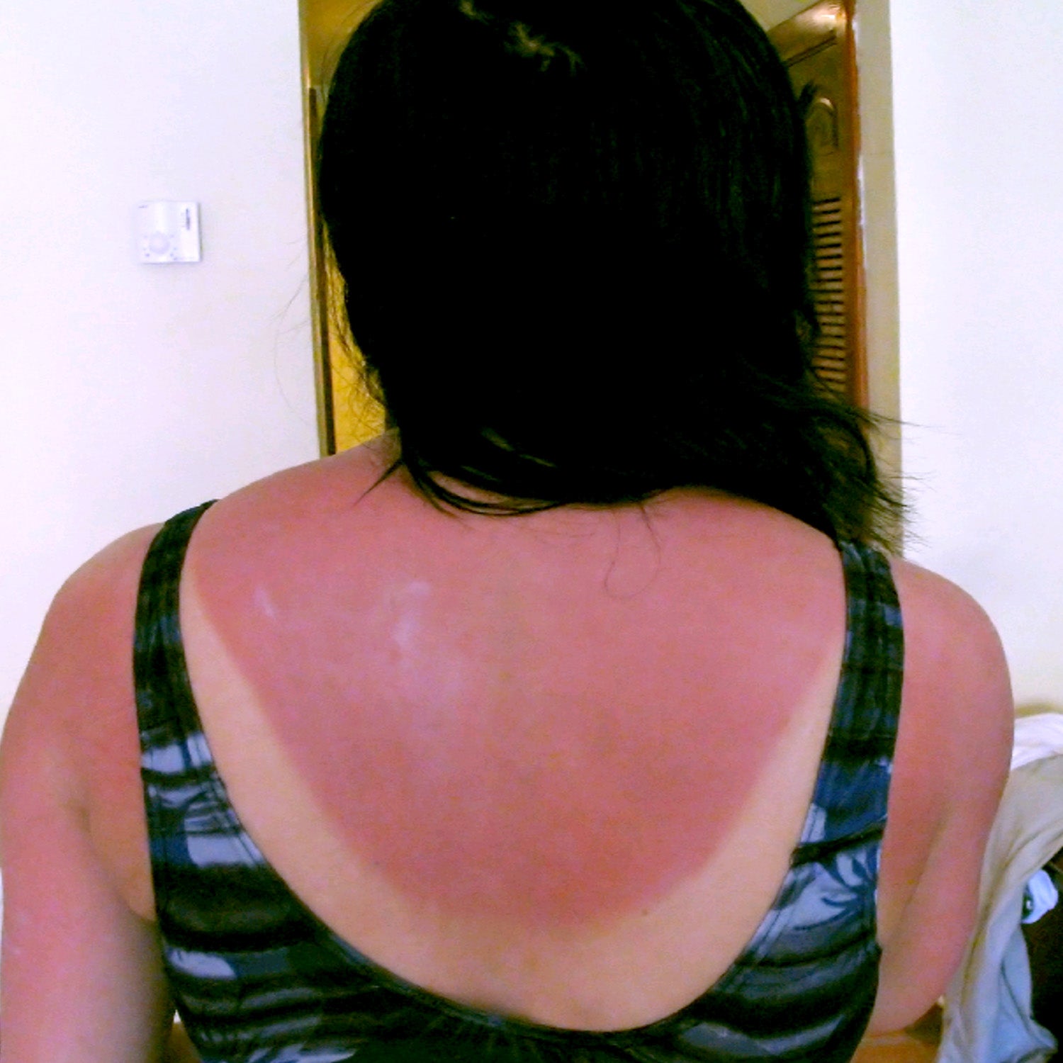 Sunburn